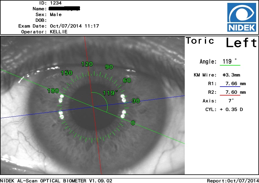 ALScan Optical Biometer