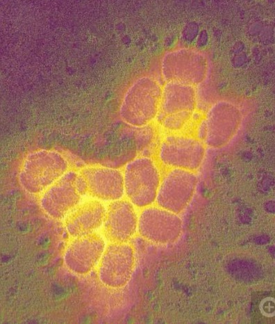 Smallpox