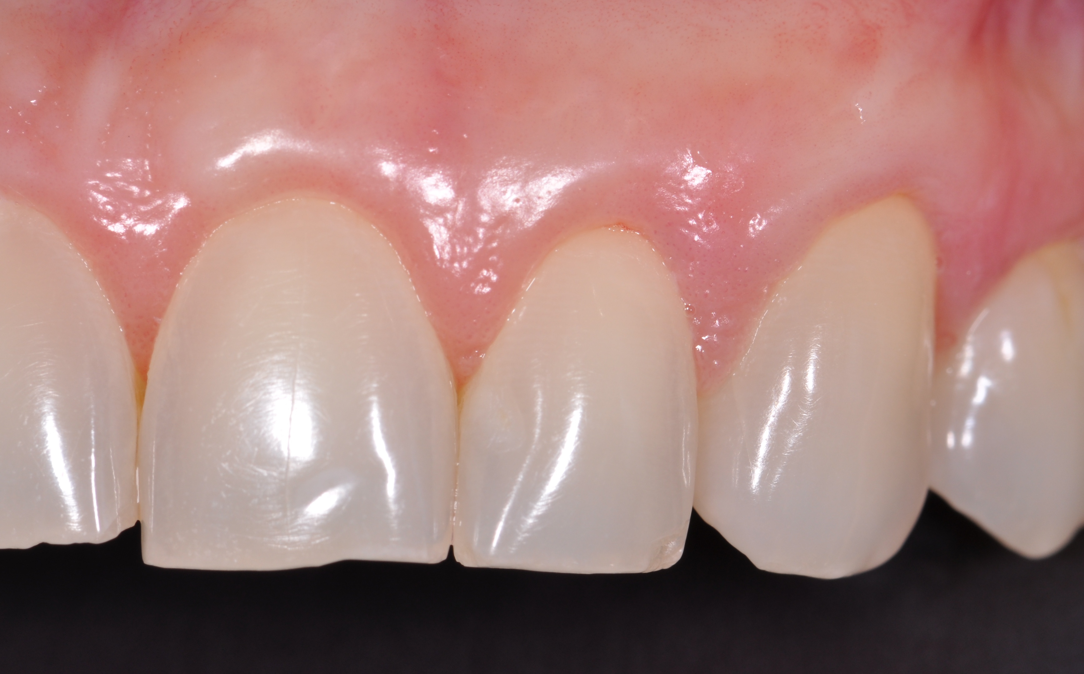 Treatment of gingival recession