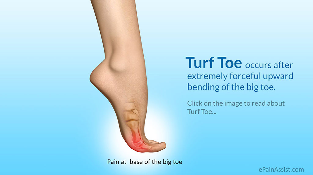 Musculoskeletal Injuries