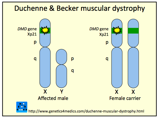Duchenne Muscular Dystrophy